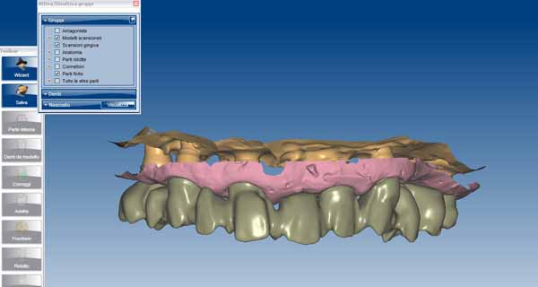 Cad cam dell'impianto