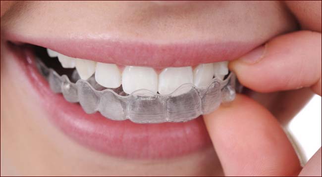 L'apparecchio invisibile
Invisalign
